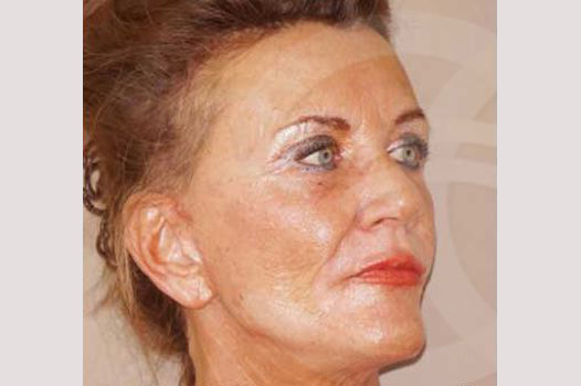 Face and Neck Lift PAVE-Facelift ante/post-op II