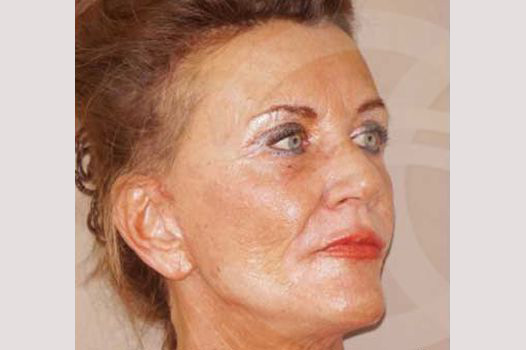 Fotos Lifting de cara y cuello  ante/post-op II