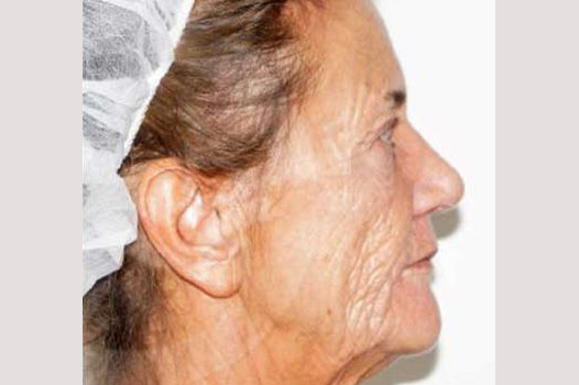 Face and Neck Lift PAVE-Facelift ante/post-op III
