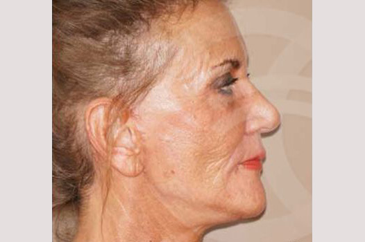 Face and Neck Lift PAVE-Facelift ante/post-op III