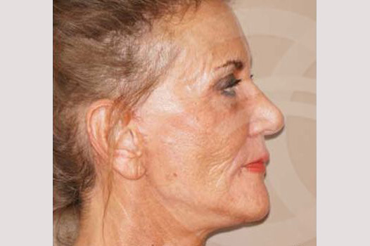 Fotos Lifting de cara y cuello  ante/post-op III