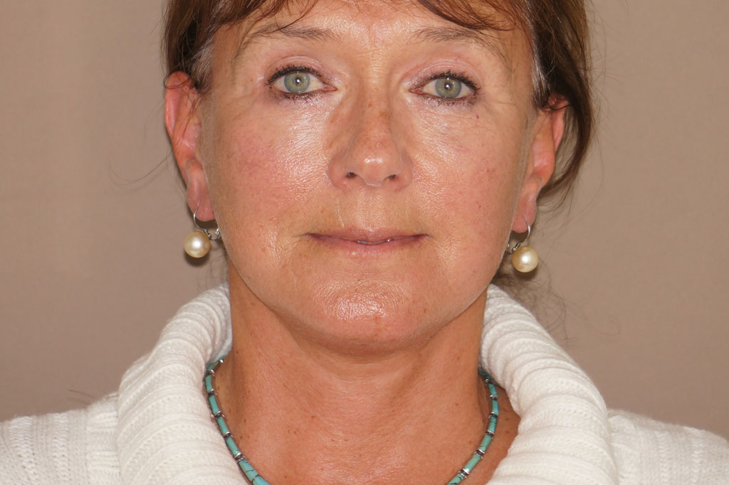 Face and Neck Lift PAVE with Lipografting post-op profil
