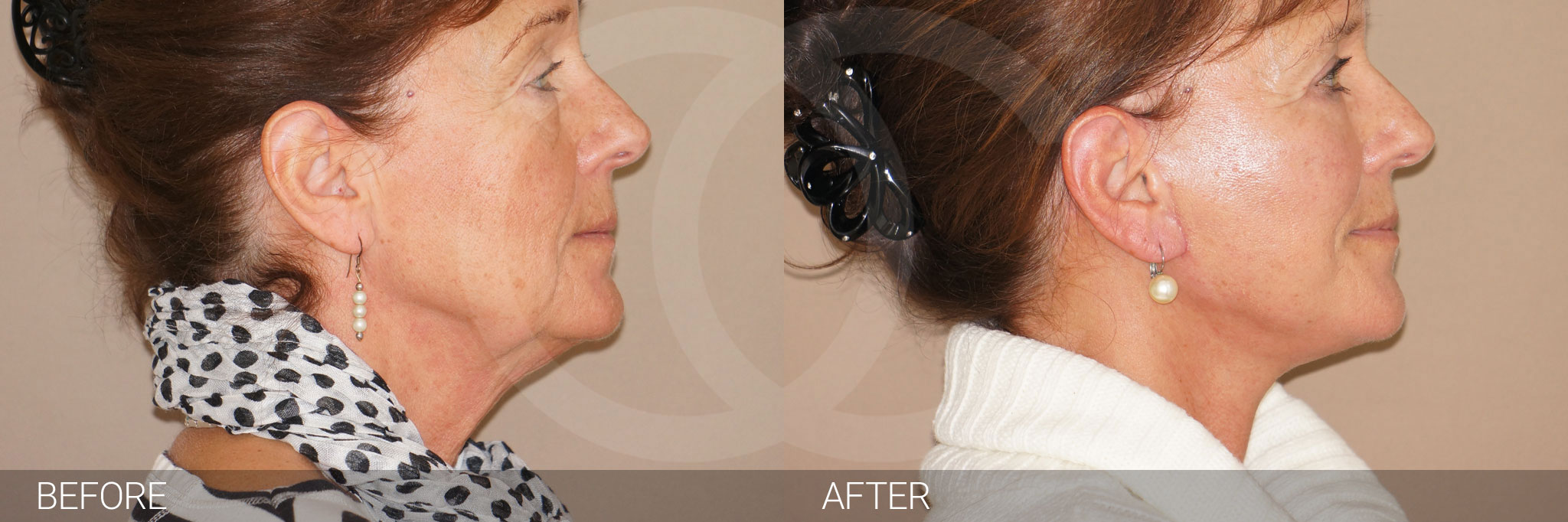 Face and Neck Lift PAVE with Lipografting ante/post-op III
