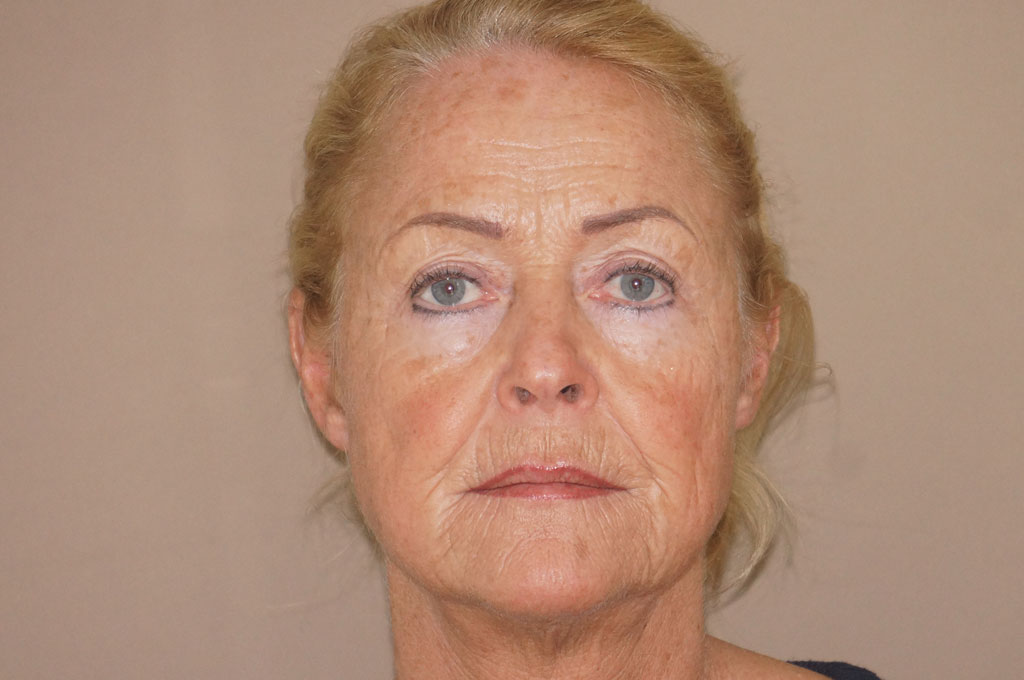 Face and Neck Lift RHYTIDECTOMY ante-op profil