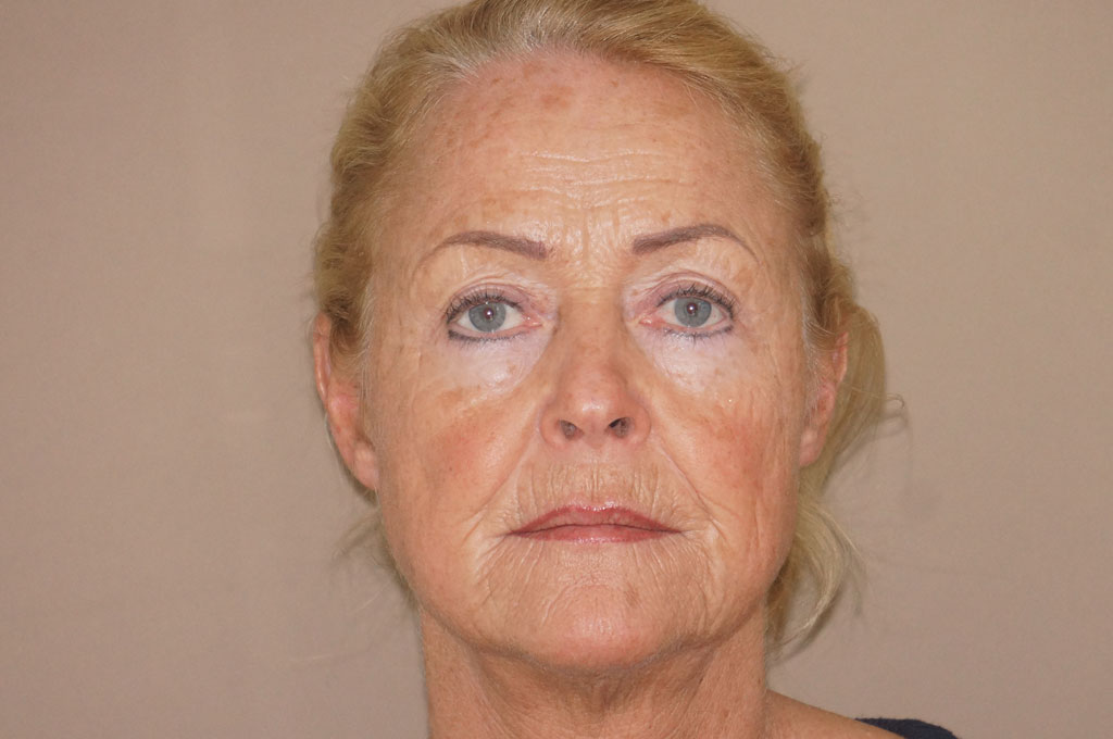 Fotos Lifting de cara y cuello  ante/post-op I