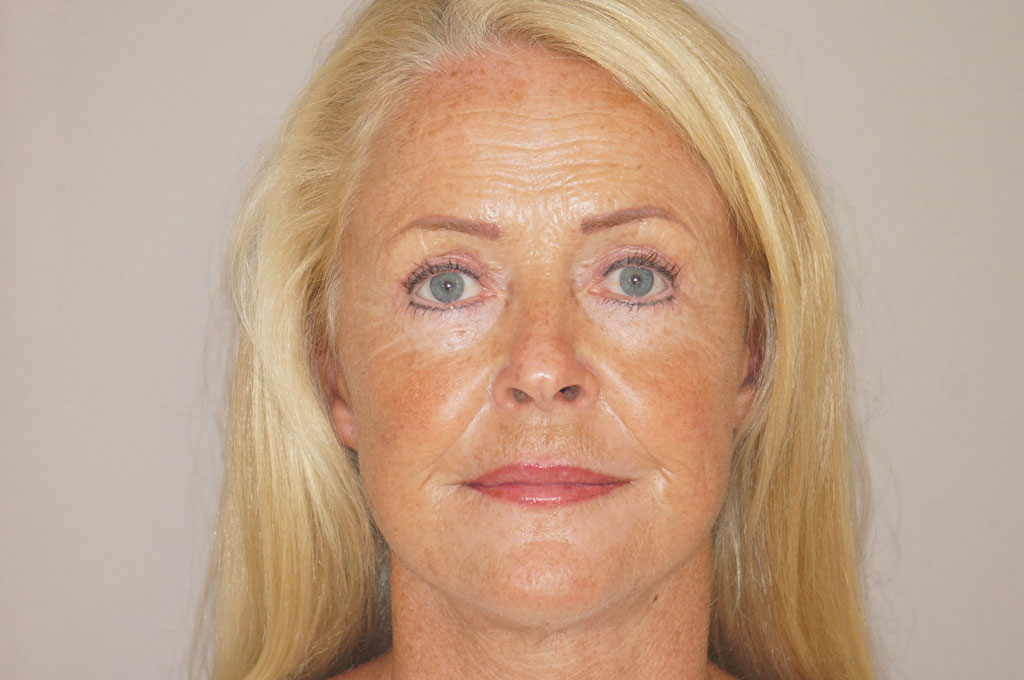 Gesichts und Halsstraffung 15 FACELIFTING BILDER RHYTIDEKTOMIE post-op profil