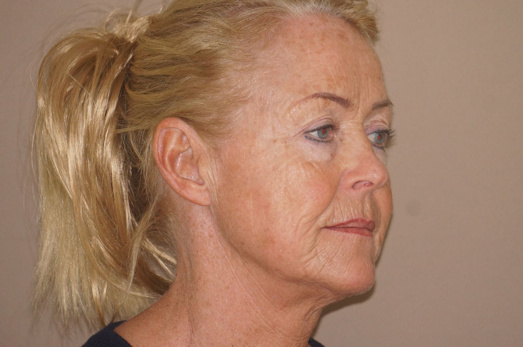 Fotos Lifting de cara y cuello  ante/post-op III