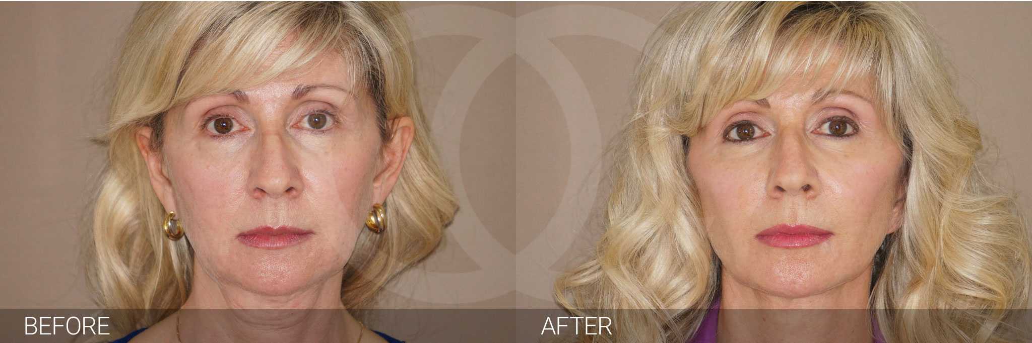 PAVE Facelift and neck lift photo before and after