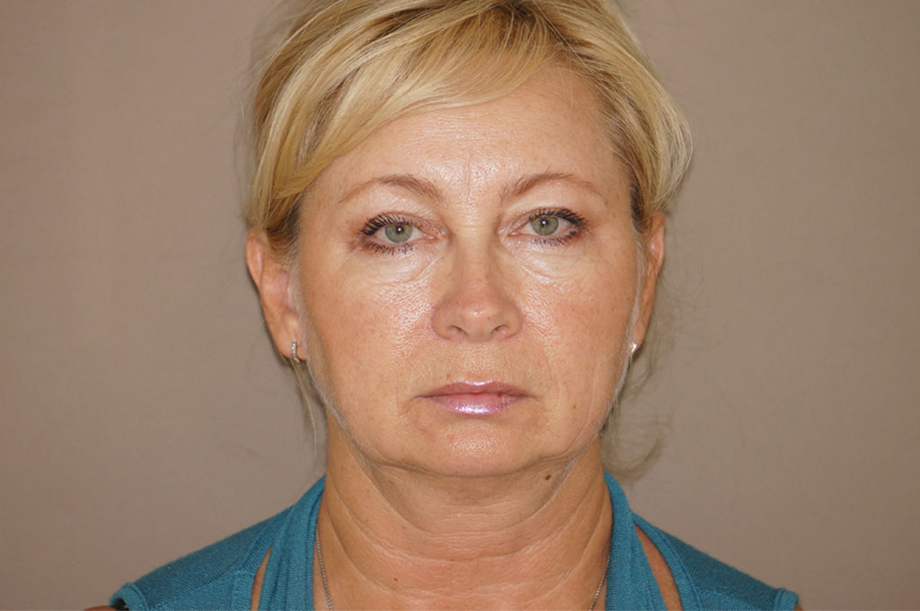 Face and Neck Lift Rhytidectomy ante-op profil