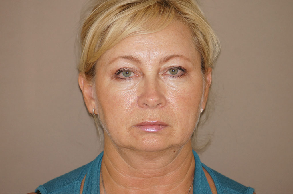 Face and Neck Lift Rhytidectomy ante/post-op I