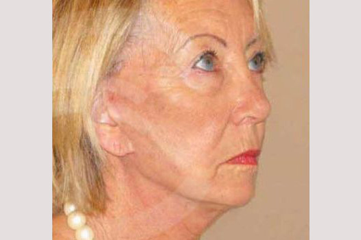 Injerto de grasa facial Lipofilling ante/post-op II