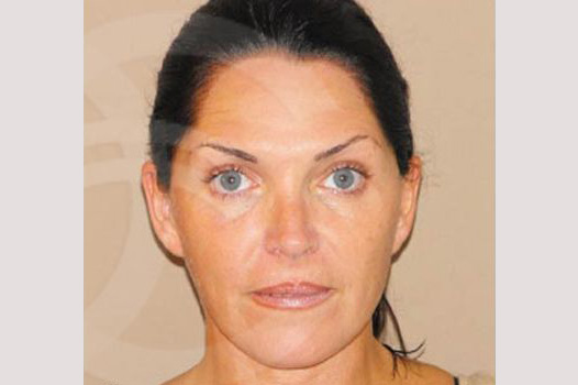 Photos Facial Fat Grafting  ante/post-op I