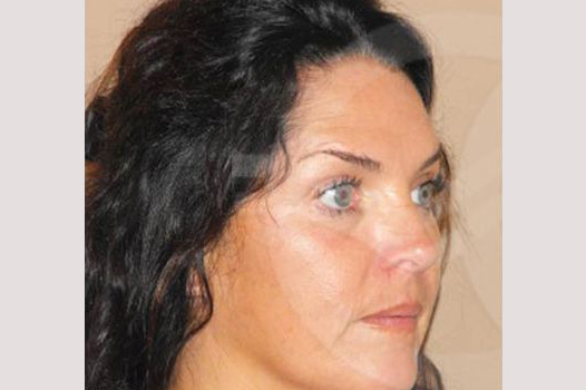 Photos Facial Fat Grafting  ante/post-op II