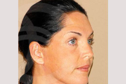 Photos Facial Fat Grafting  ante/post-op II