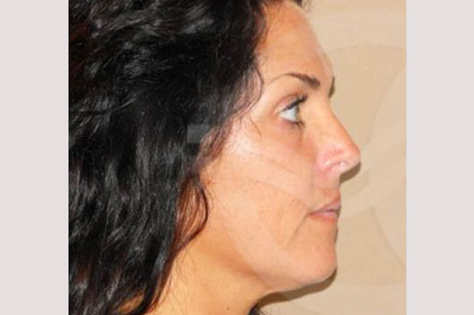 Facial Fat Grafting Mini-facelift ante/post-op III