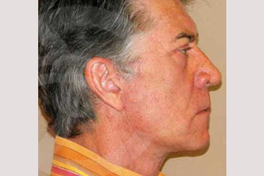 Photos Facial Fat Grafting  ante/post-op III