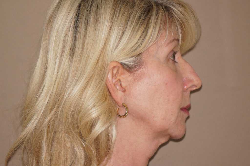 Lipofilling du visage 1 ante-op retro/lateral