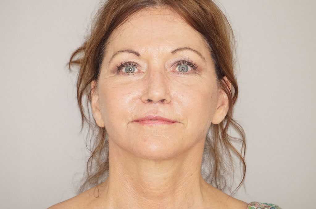 Lipofilling du visage 2 post-op profil