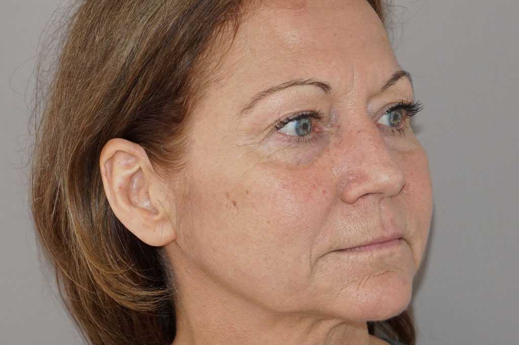 Lipofilling du visage 2 ante-op lateral