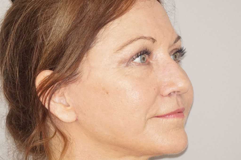 Facial Fat Grafting FULL WITH FAT TRANSFER post-op lateral