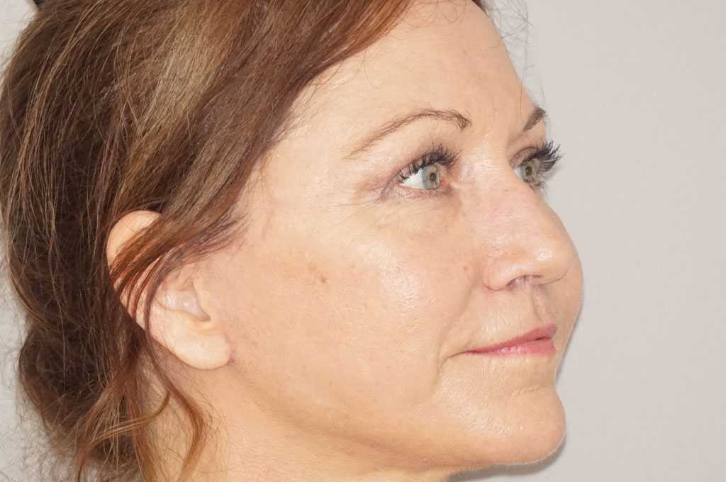 Facial Fat Grafting FULL WITH FAT TRANSFER ante/post-op II