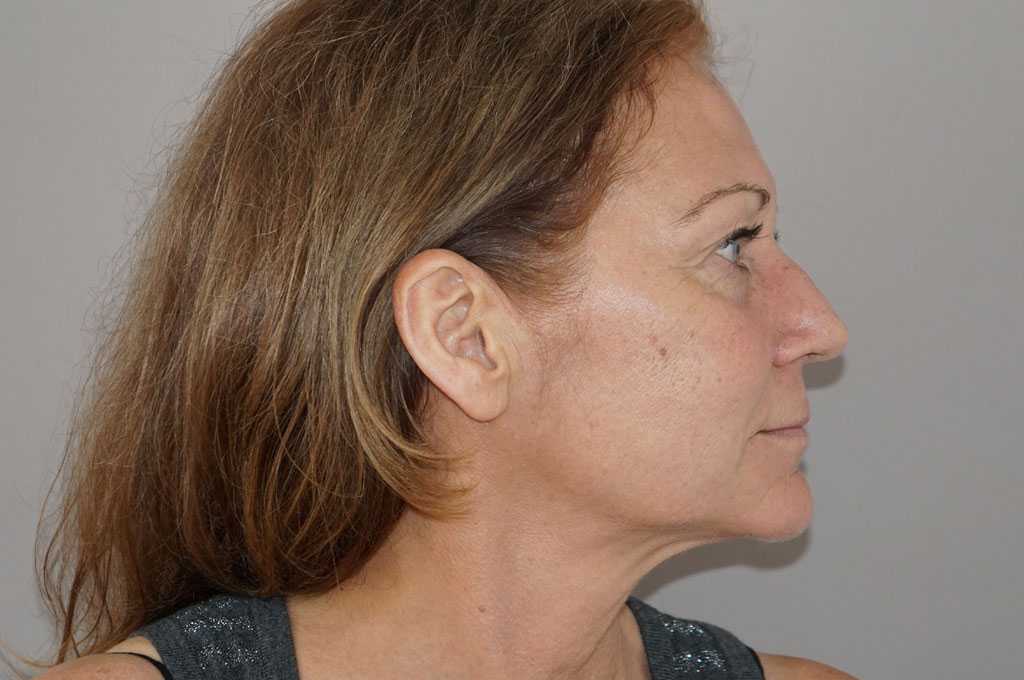 Lipofilling du visage 2 ante-op retro/lateral