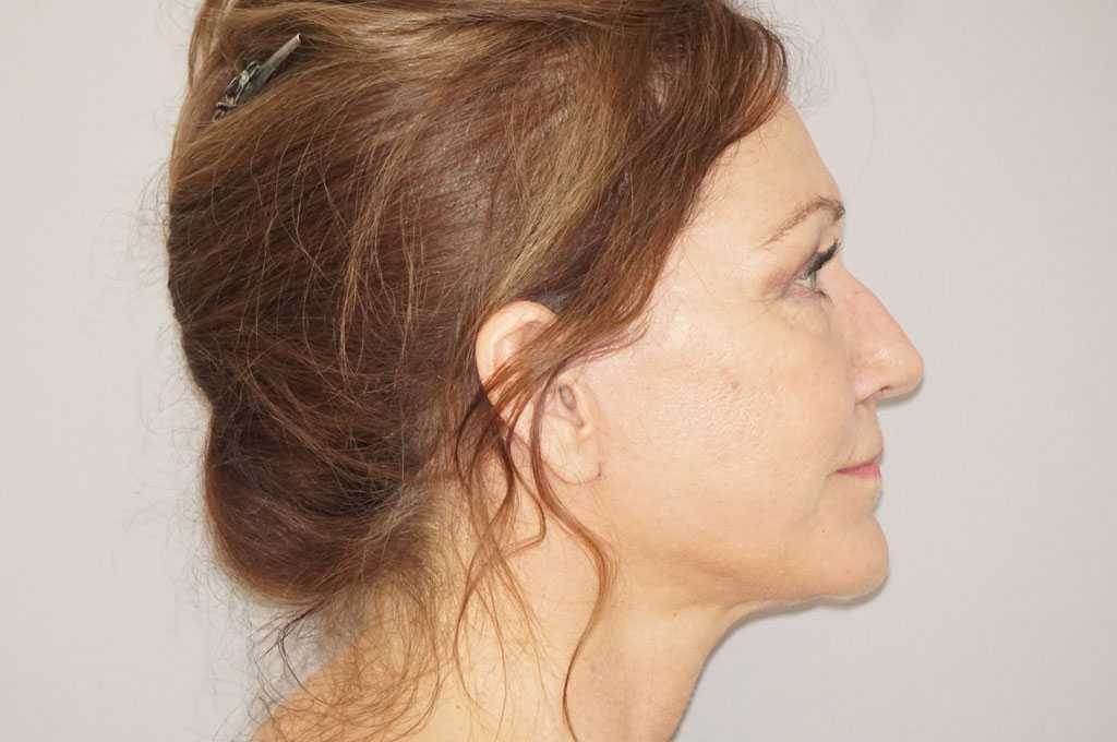 Lipofilling du visage 2 post-op retro/lateral