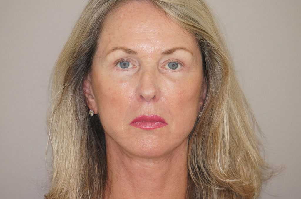 Facial Fat Grafting PAVE-FACELIFT ante/post-op I