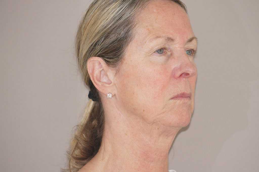 Facial Fat Grafting PAVE-FACELIFT ante/post-op II