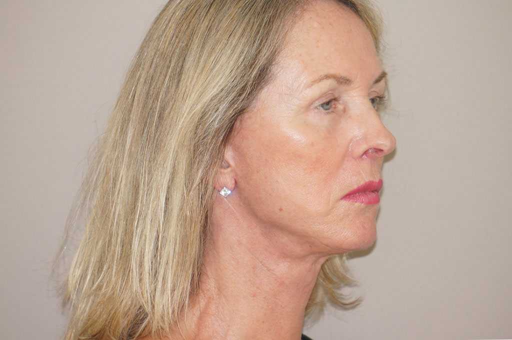 Facial Fat Grafting PAVE-FACELIFT ante/post-op II