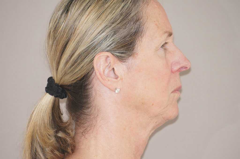 Facial Fat Grafting PAVE-FACELIFT ante/post-op III