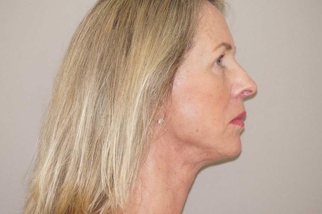 Lipofilling du visage 3 post-op retro/lateral