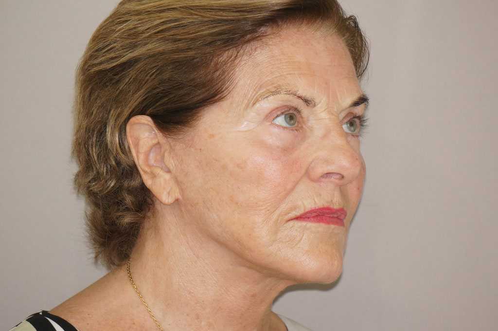 Gesichtsbehandlung mit Eigenfett 13 PAVE LIFTING FACELIFTING MIT EIGENFETT post-op lateral