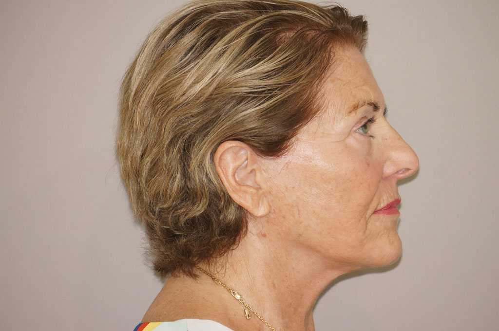 Injerto de grasa facial PAVE-LIFTING DE LA CARA ante/post-op III