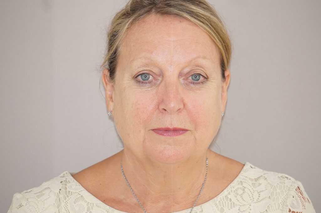 Facial Fat Grafting PAVE FACELIFT ante/post-op I