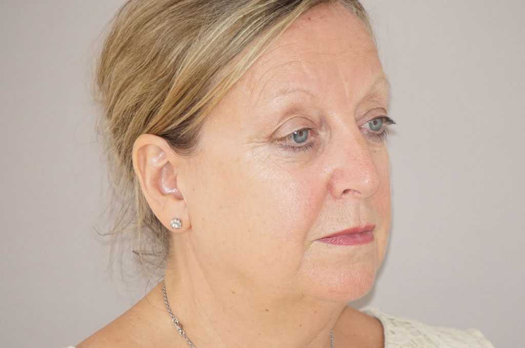 Facial Fat Grafting PAVE FACELIFT ante/post-op II