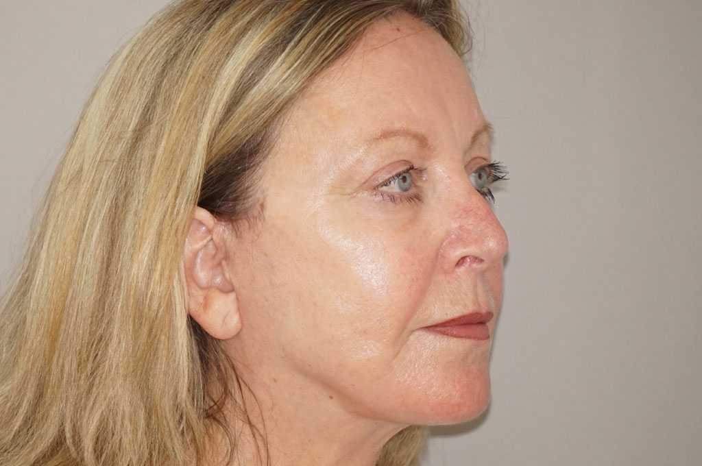 Gesichtsbehandlung mit Eigenfett 18 FACELIFTING MIT EIGENFETT-TRANSFER PAVE LIFTING post-op lateral