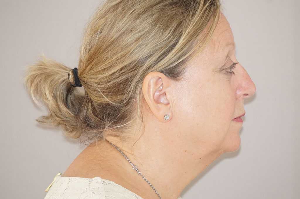 Lipofilling du visage 5 ante-op retro/lateral