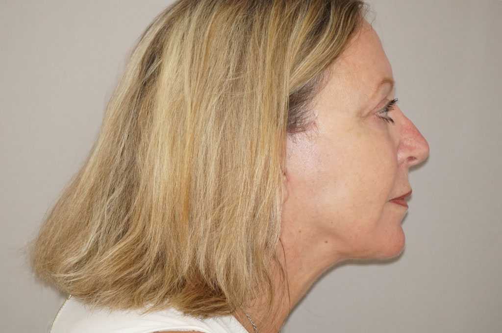 Lipofilling du visage 5 post-op retro/lateral