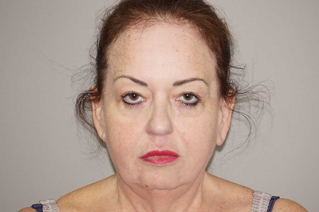 Facial Fat Grafting Facelift and Necklift ante/post-op I