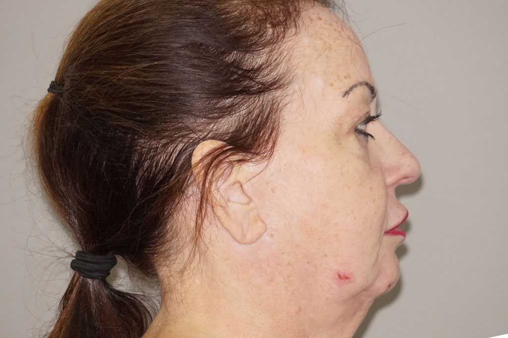 Injerto de grasa facial SMAS cara y cuello  ante/post-op III