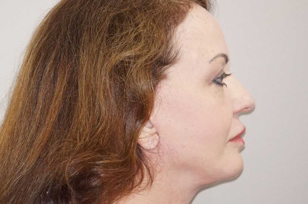 Lipofilling du visage 6 post-op retro/lateral