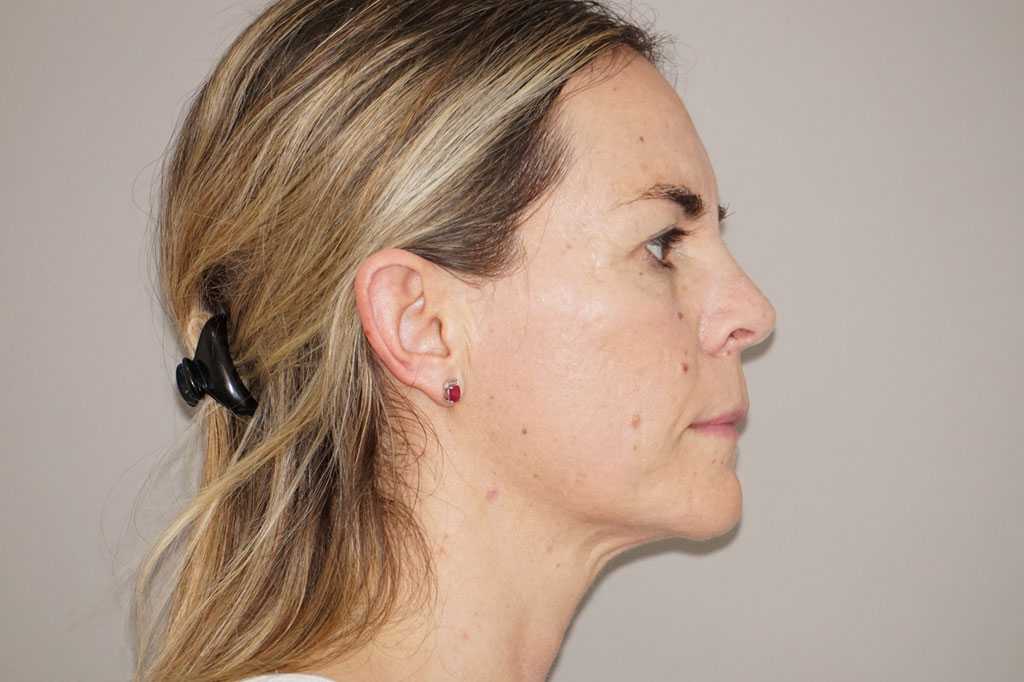 Gesichtsbehandlung mit Eigenfett Fetttransfer vom Bauch ante-op retro/lateral