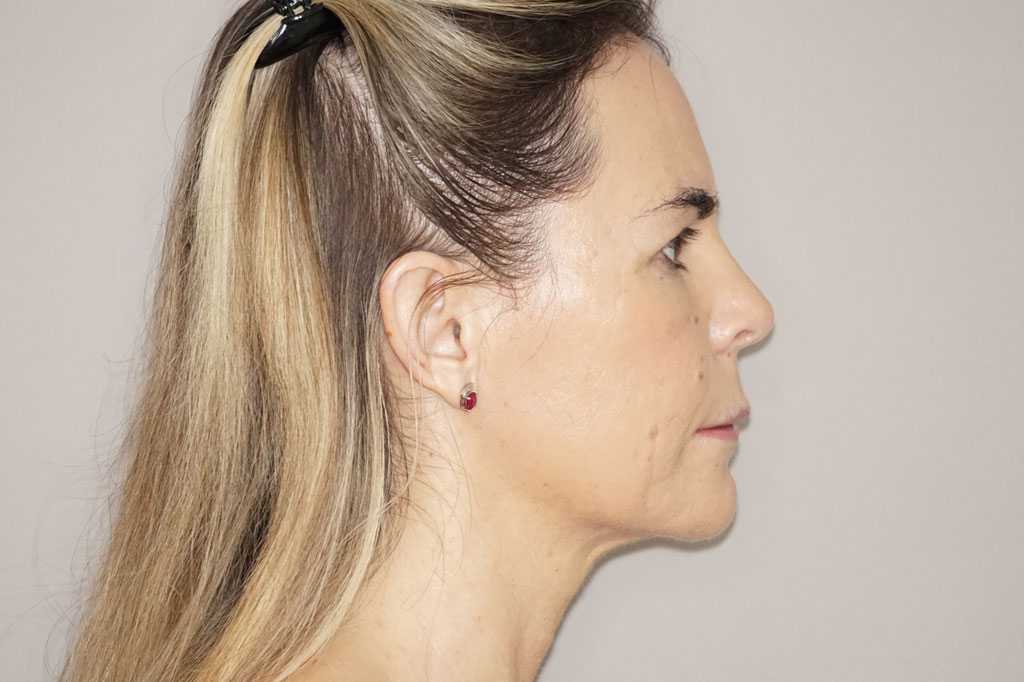 Gesichtsbehandlung mit Eigenfett Fetttransfer vom Bauch post-op retro/lateral
