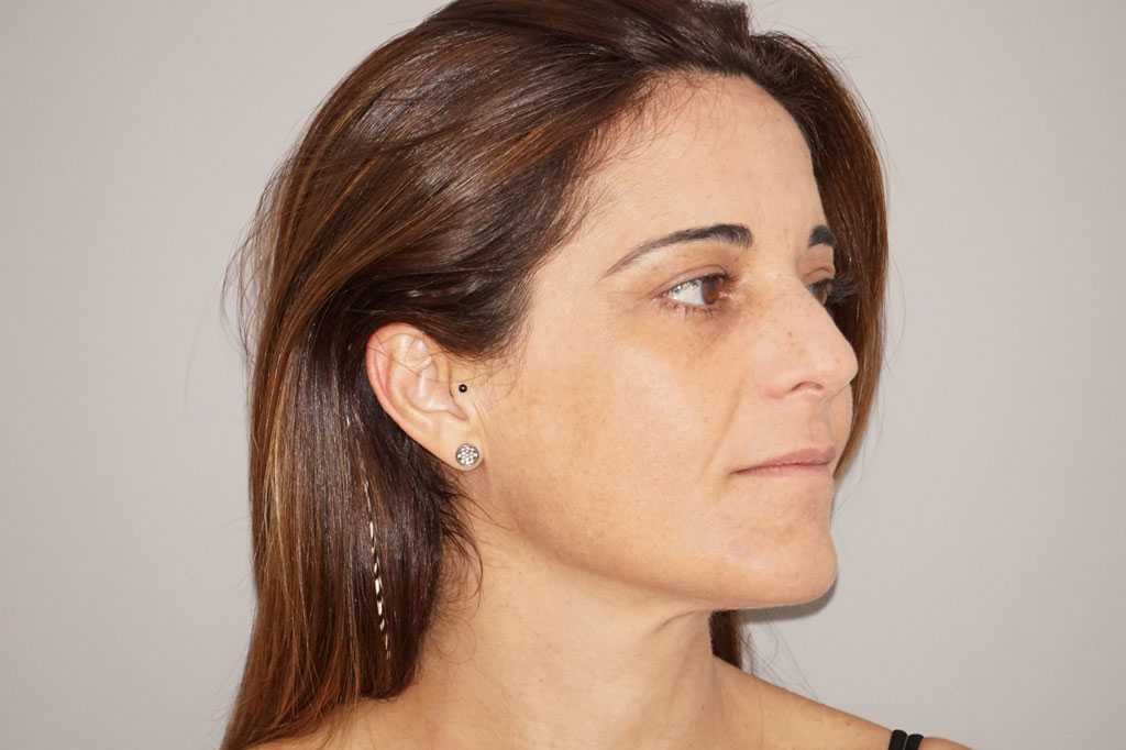 Gesichtsbehandlung mit Eigenfett Gesichtsvolumenverlust ante-op lateral