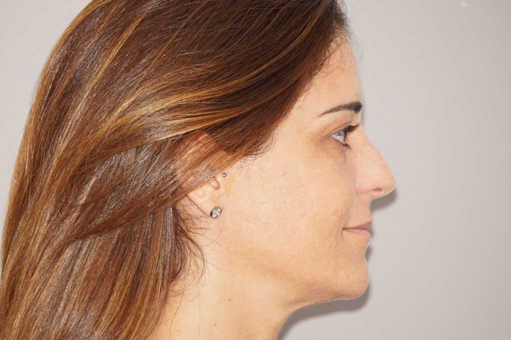 Gesichtsbehandlung mit Eigenfett Gesichtsvolumenverlust ante-op retro/lateral