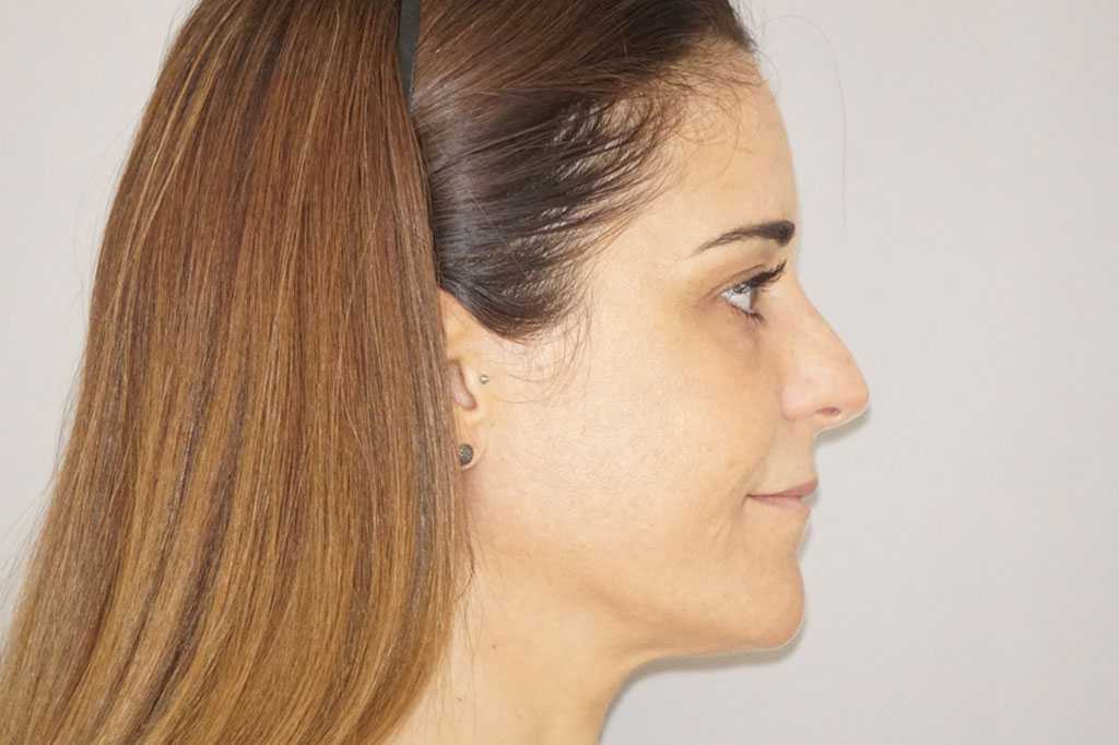 Injerto de grasa facial Pérdida de volumen facial ante/post-op III