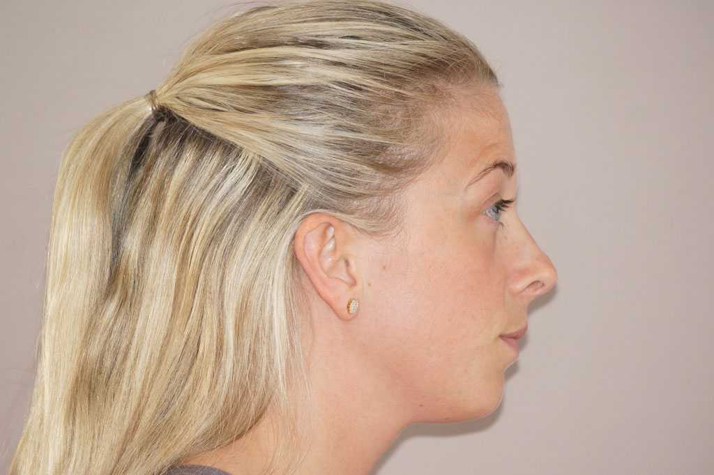Cirugía de la nariz RINOPLASTIA post-op retro/lateral