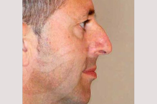 Nose Correction CLOSED RHINOPLASTY ante/post-op II