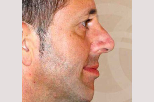 Cirugía de la nariz RINOPLASTIA CERRADA ante/post-op II
